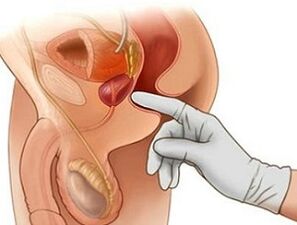 Eesnäärme massaaž prostatiidi raviks meestel