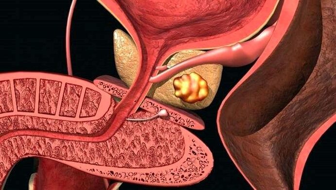 Kivide ladestumine eesnäärmes koos kalkulaarse prostatiidiga