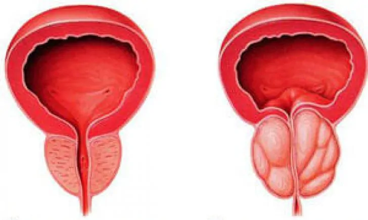 Normaalne eesnääre (vasakul) ja põletikuline krooniline prostatiit (paremal)