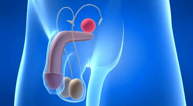 Prostatiit on meeste eesnäärmepõletik, mis vajab kompleksset ravi